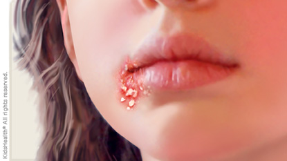 Mouth:Wrsgm8zbemq= Impetigo